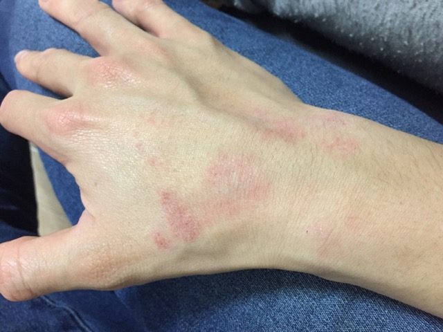 アトピー改善前の右手